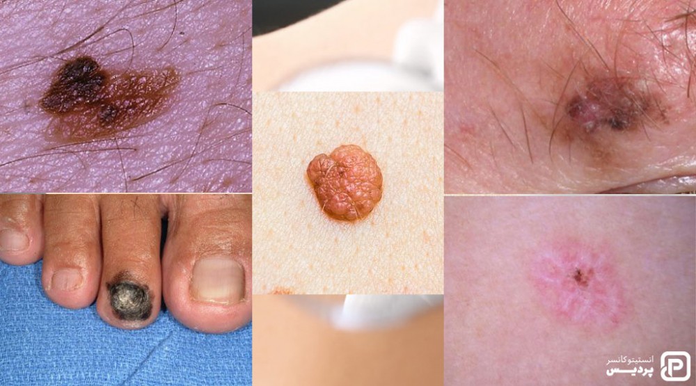 سرطان پوست ملانوما چیست 3 علائم ملانوما