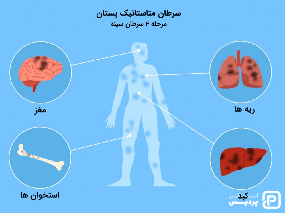 سرطان متاستاتیک سینه، علائم و نشانه ها و راههای درمان آن 4 سرطان متاستاتیک پستان