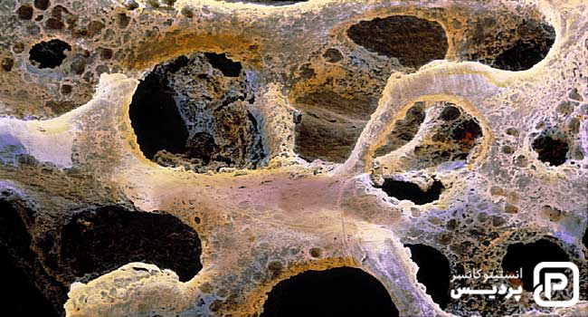 سرطان متاستاتیک سینه، علائم و نشانه ها و راههای درمان آن 2 سرطان متاستاتیک پستان