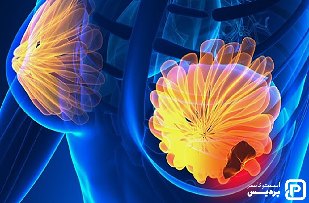 مرحله بندی سرطان سینه به چه صورت است