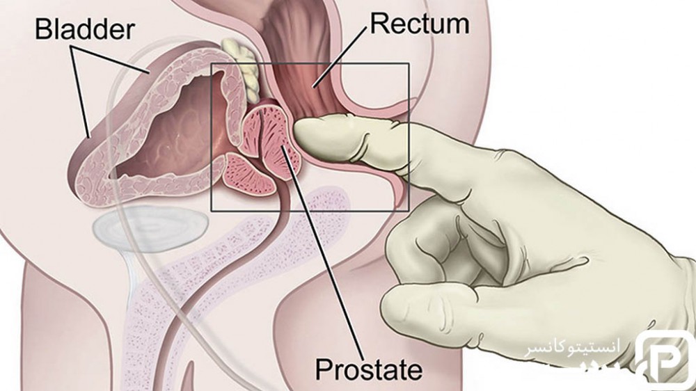 سرطان پروستات 