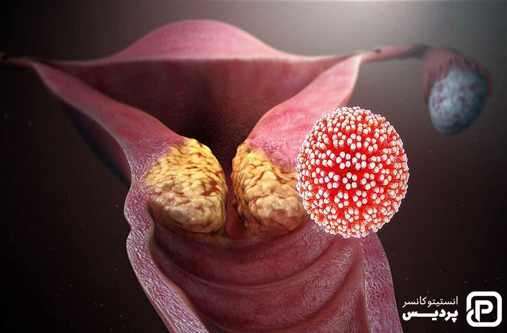 انواع جراحی برای درمن سرطان دهانه رحم