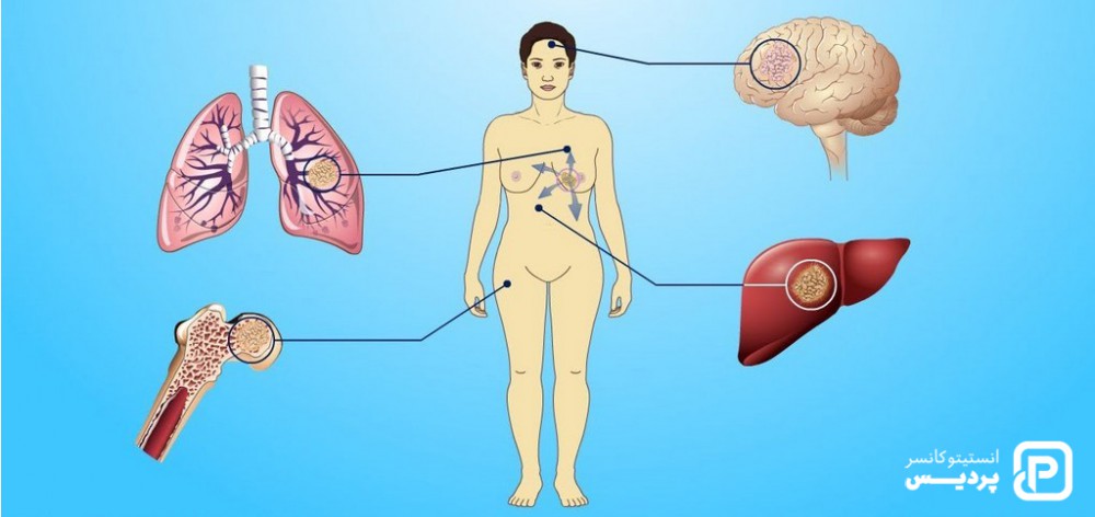 انواع نادر سرطان پستان