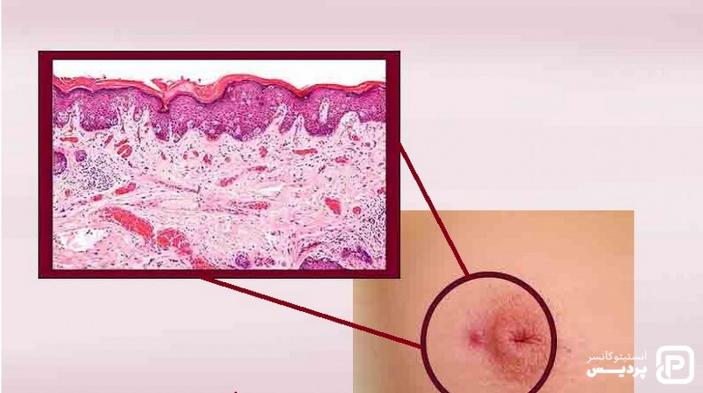 انواع نادر سرطان پستان