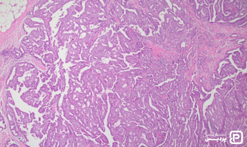 انواع نادر سرطان پستان