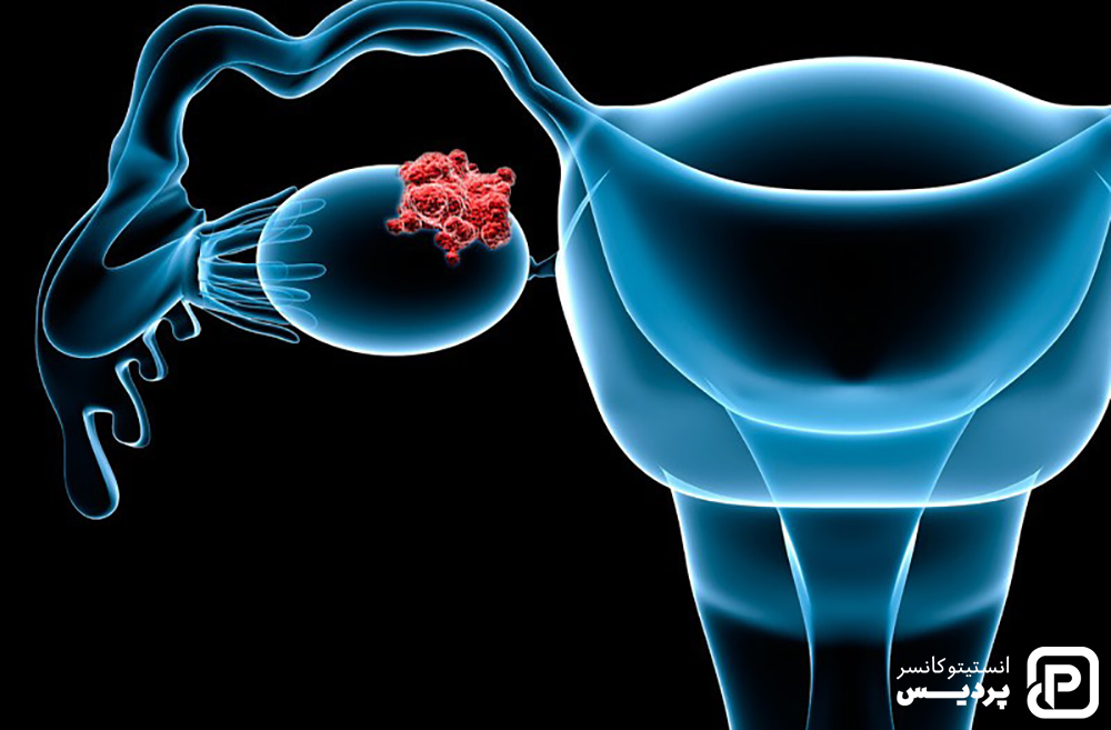 مرحله بندی سرطان تخمدان و درمان آن ها
