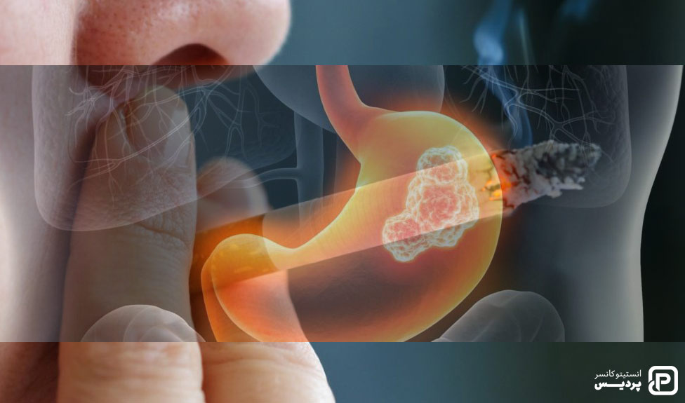 ترک سیگار برای پیشگیری از سرطان معده