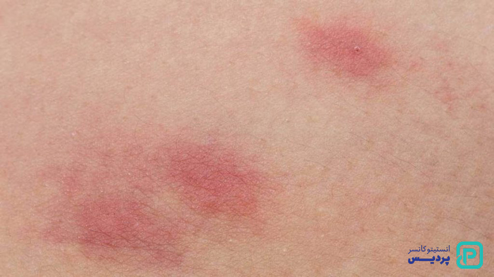 سرطان پوست سلول پایه و سنگفرشی 5 سرطان پوست خوش خیم و بد خیم