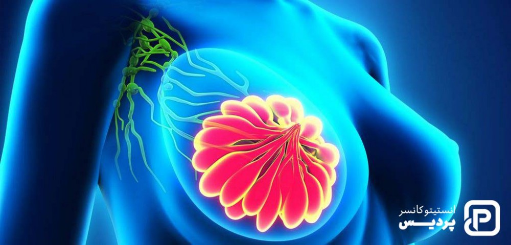 درجه بندی سرطان سینه چگونه است و چه معیارهایی دارد؟ 4 مراحل سرطان پستان