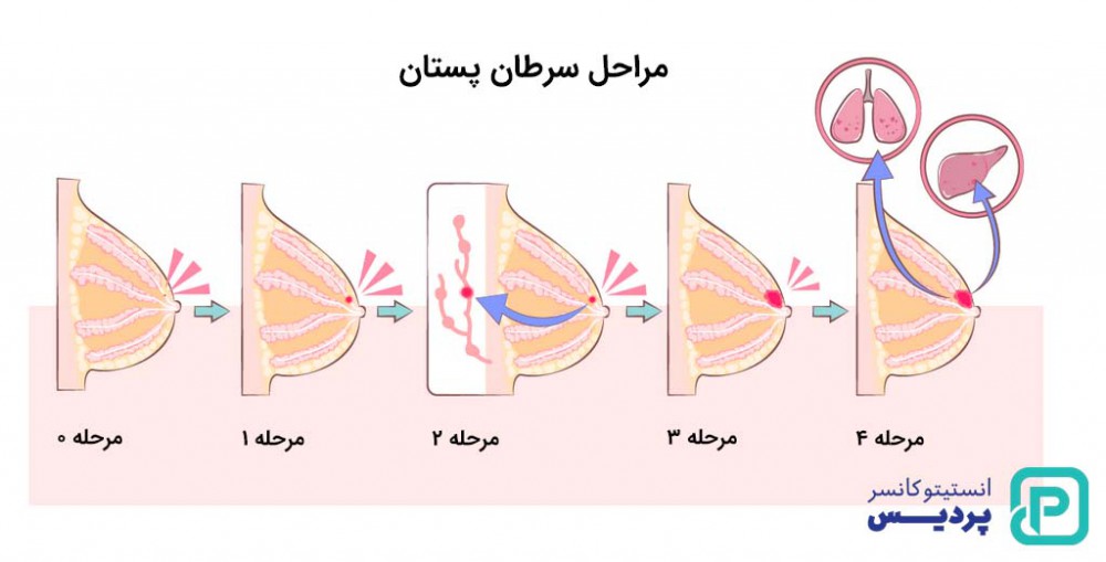 درجه بندی سرطان سینه چگونه است و چه معیارهایی دارد؟ 3 درجه بندی سرطان سینه