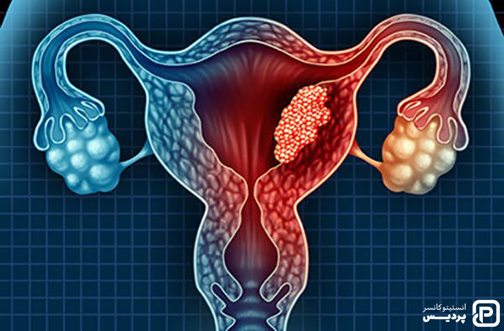 چگونگی تشخیص سرطان دهانه رحم