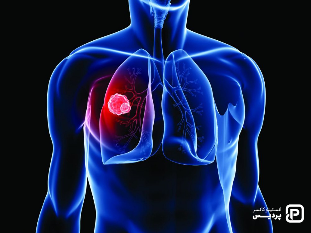 عوامل خطر سرطن ریه غیر قابل تغییر