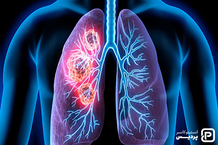 سرطان ریه چیست 5 شانس ابتلا به سرطان ریه در طول زندگی