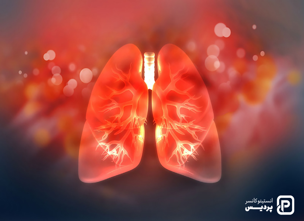 عوامل خطر سرطان ریه چه چیز هایی هستند