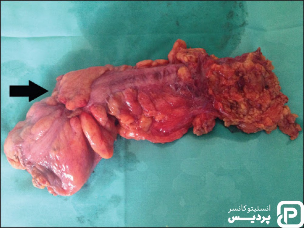 پیشرفت سرطان روده چگونه اندازه گیری می شود؟