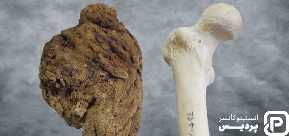 انواع سرطان استخوان