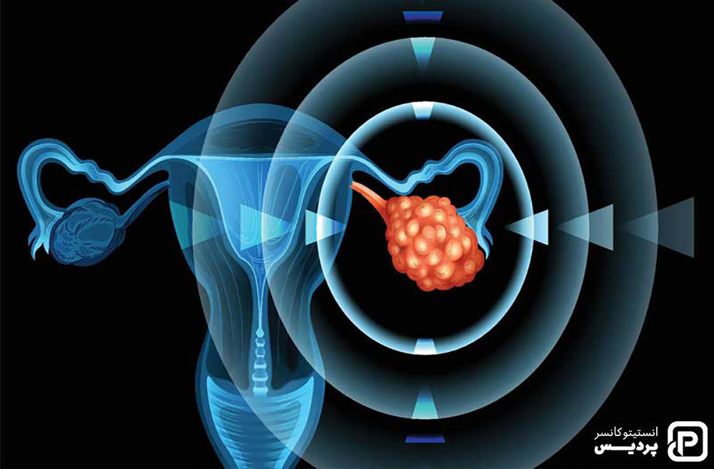 روش های درمانی سرطان تخمدان را بشناسید 6 سرطان تخمدان و راه های درمان آن
