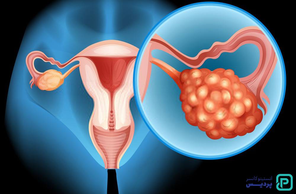 7 عامل افزایش خطر سرطان تخمدان 6 همه چیز در رابطه با عوامل خطر سرطان تخمدان