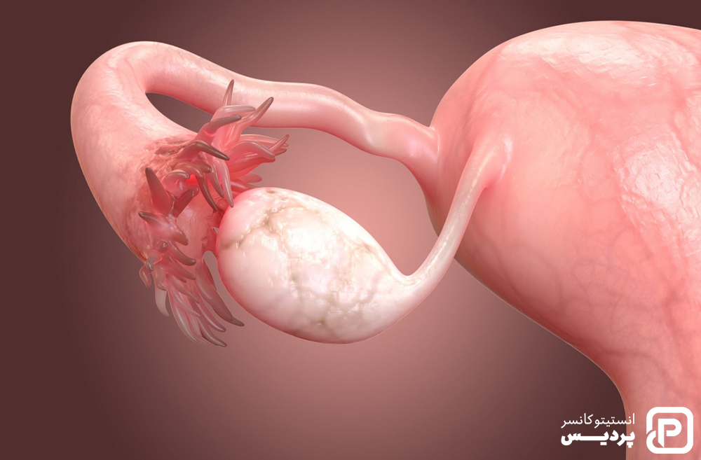 سرطان تخمدان را بیشتر بشناسید 3 سرطان تخمدان را بشناسید