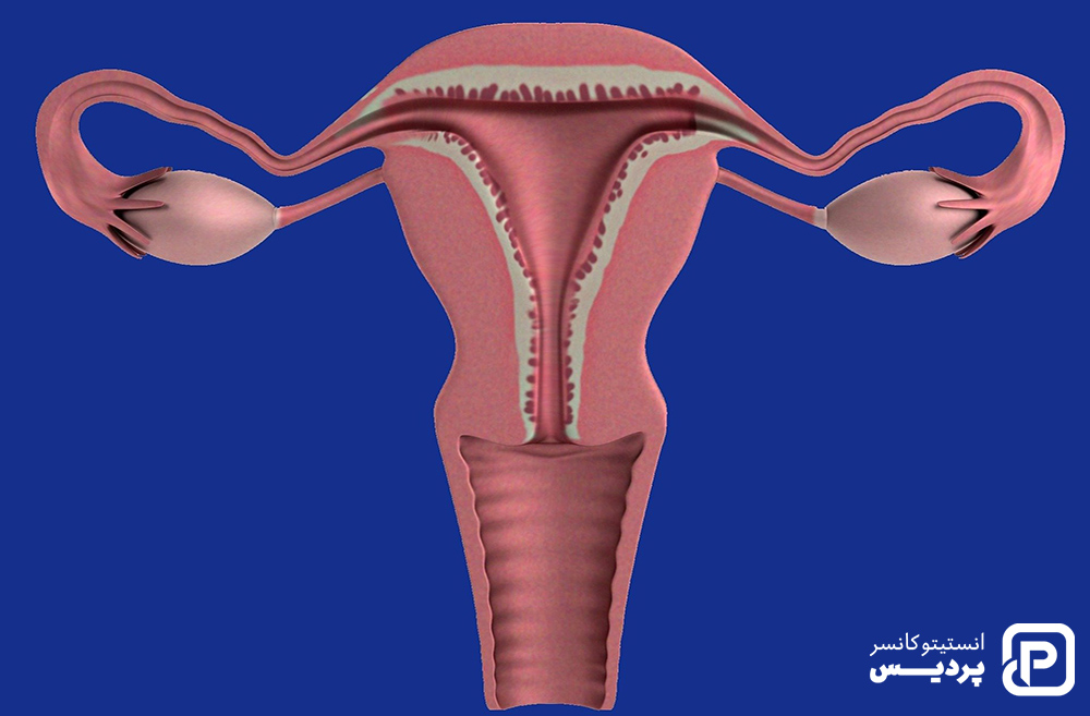 سرطان تخمدان را بیشتر بشناسید 7 مرحله بندی سرطان تخمدان