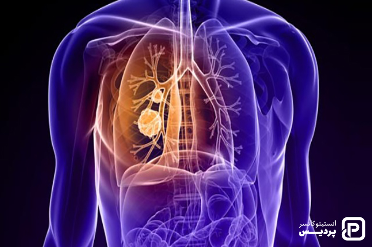 سرطان ریه چیست 4 چگونگی بوجود آمدن سرطان ریه