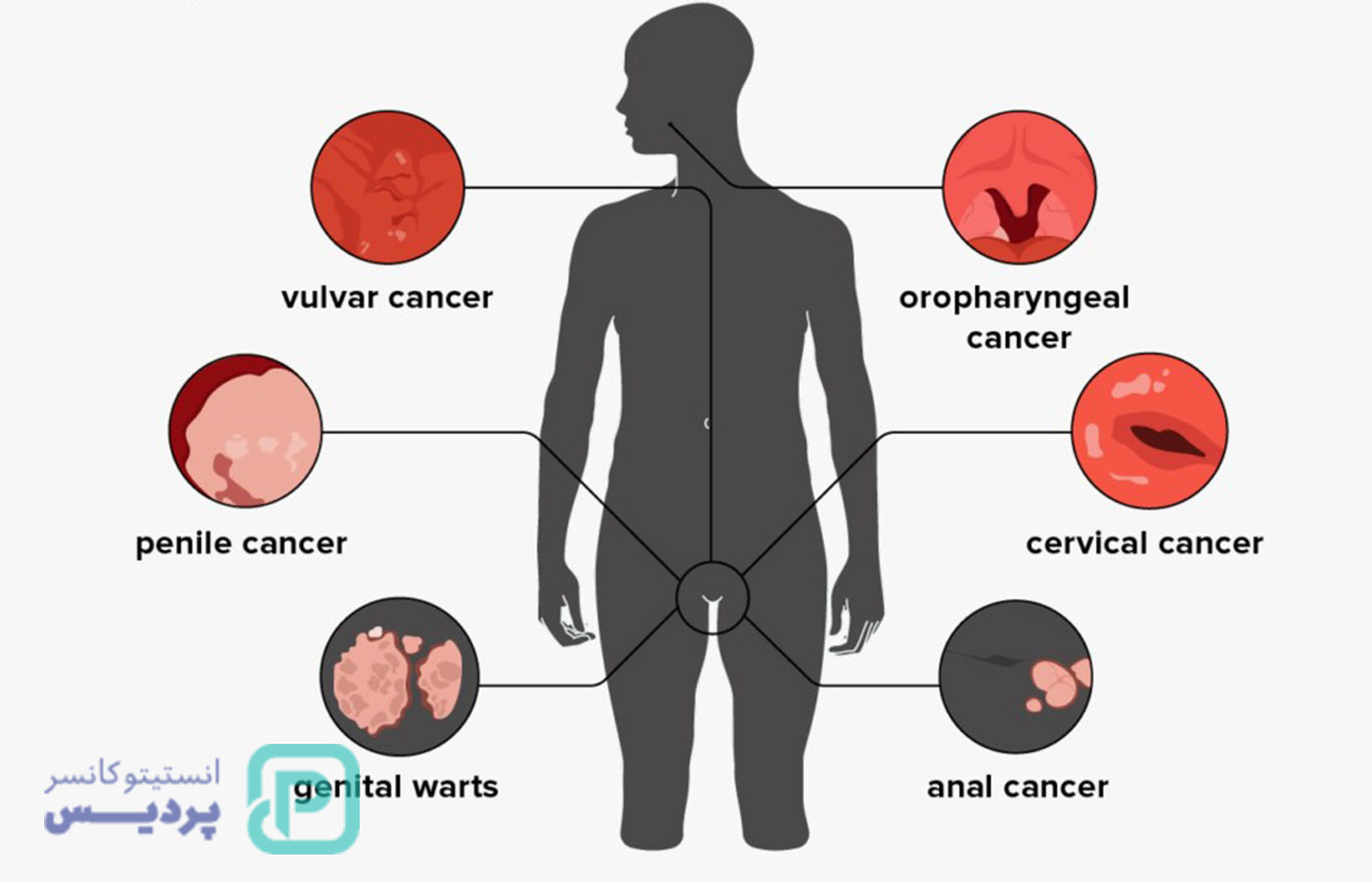 راهنمای جامع آزمایش HPV: از روش‌های تست تا تفسیر دقیق نتایج - 4