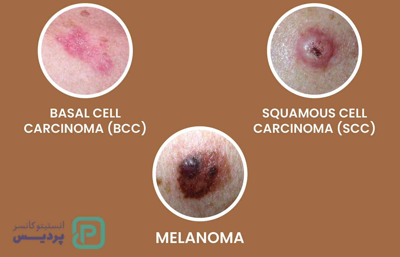 کارسینوم چیست؟ انواع، علائم و روش‌های درمانی این سرطان - 2