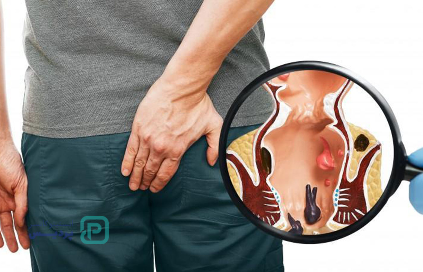 تفاوت بواسیر و سرطان مقعدی | چگونه تفاوت را تشخیص دهیم؟ 2 تفاوت بواسیر و سرطان مقعدی | چگونه تفاوت را تشخیص دهیم؟ - 2