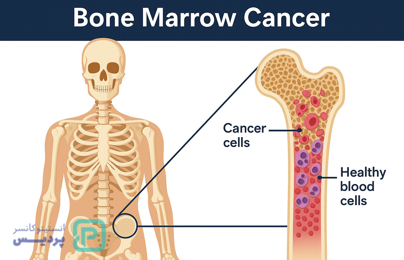 سرطان مغز استخوان چیست؟ علائم، انواع و روش‌های درمان مؤثر - 4