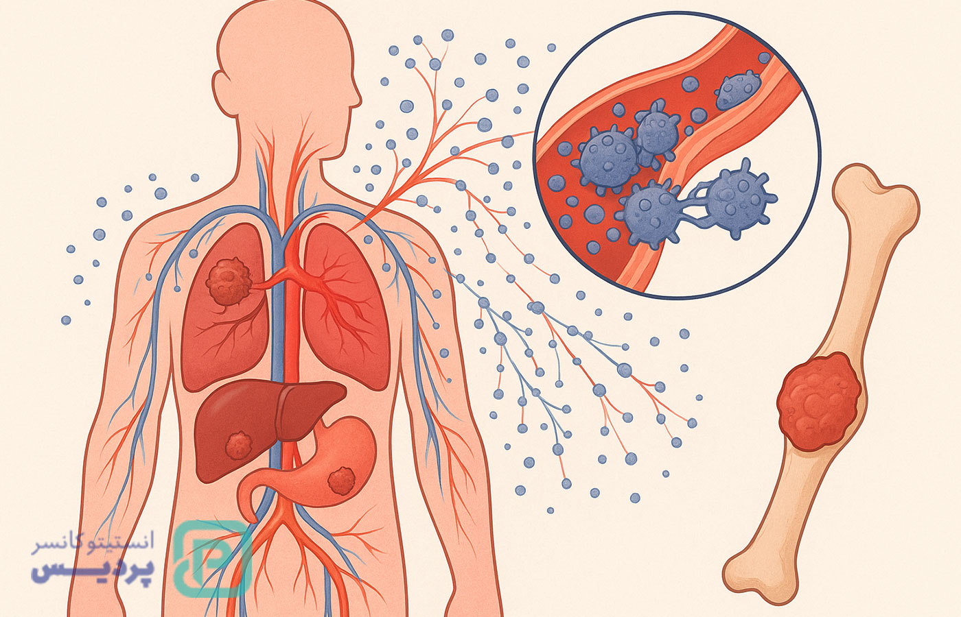 متاستاز چیست؟ همه چیز درباره گسترش سرطان به زبان ساده - 4