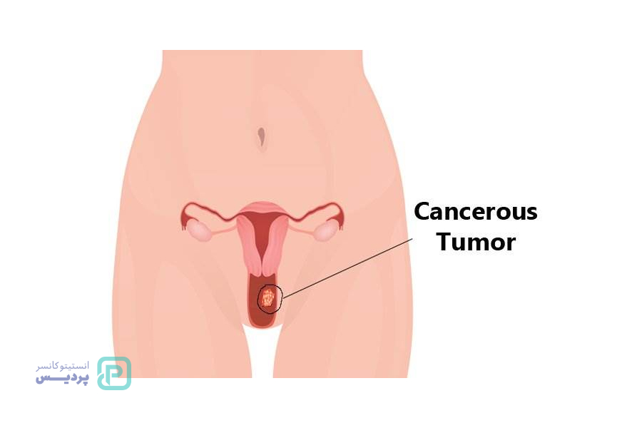 انواع سرطان: آشنایی با علائم، روشهای تشخیص و درمان 12 سرطان دهانه رحم