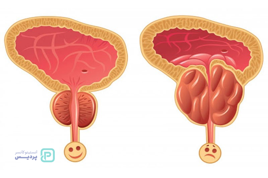 انواع سرطان: آشنایی با علائم، روشهای تشخیص و درمان 13 سرطان پروستات