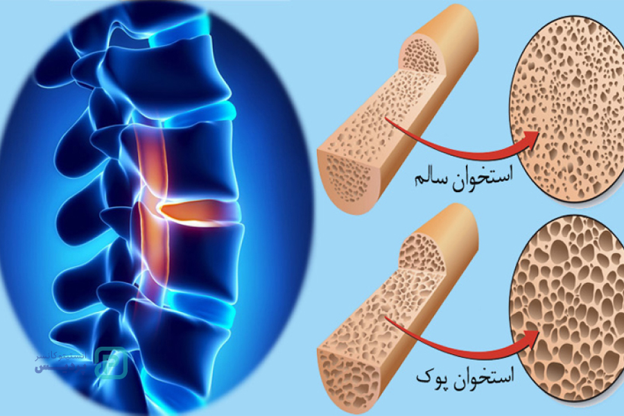 نتایج آزمایش سنجش تراکم استخوان چگونه تفسیر می شوند؟