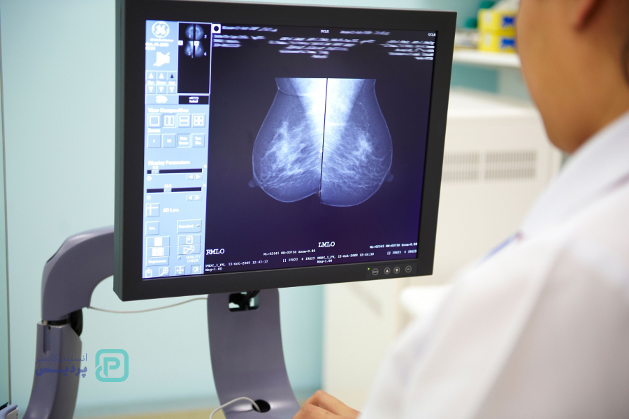 چه کسانی به غربالگری سرطان سینه نیاز دارند؟