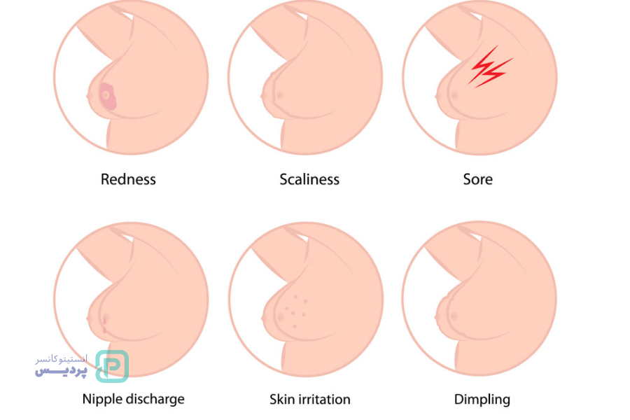 غربالگری سرطان پستان یا سینه چیست و چگونه انجام می شود؟ 6 علائم هشدار دهنده سرطان پستان