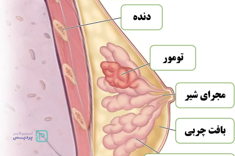 سرطان پستان: شایع‌ترین سرطان زنان، قابل پیشگیری و درمان