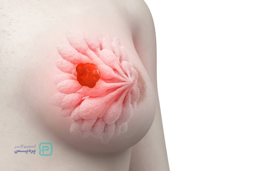 غربالگری سرطان سینه برای چه کسانی ضروری است؟