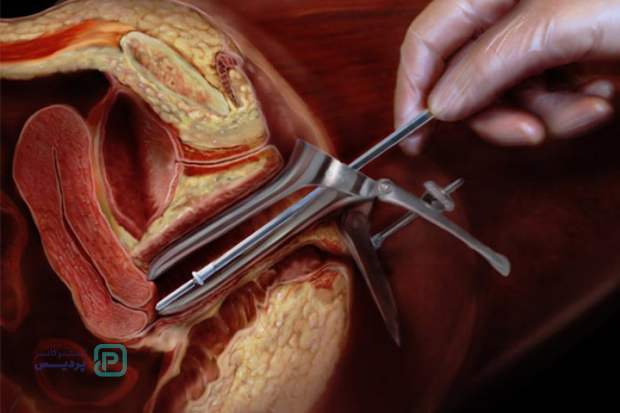 بهترین زمان تست پاپ اسمیر چه زمانی است؟ 5 چرا تست پاپ اسمیر انجام میشود؟