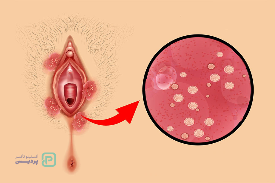 بهترین زمان تست پاپ اسمیر چه زمانی است؟ 8 آیا آزمایش پاپ اسمیر زگیل تناسلی را نشان میدهد؟