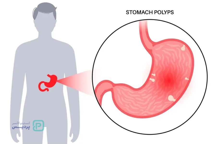 انواع سرطان: آشنایی با علائم، روشهای تشخیص و درمان 6 سرطان معده