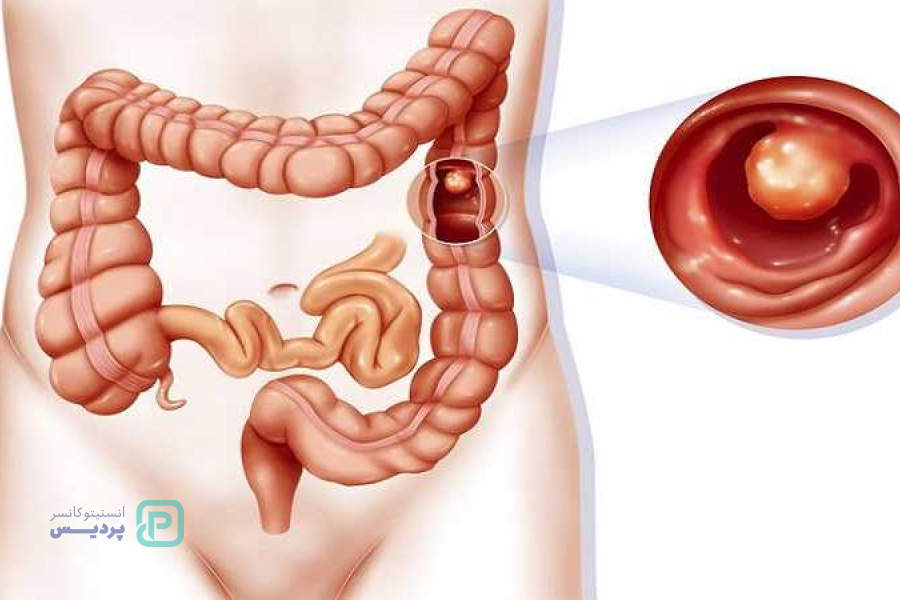انواع سرطان: آشنایی با علائم، روشهای تشخیص و درمان 7 سرطان روده