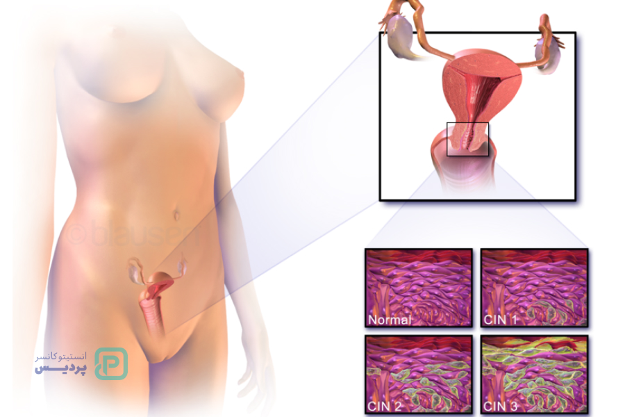 غربالگری سرطان دهانه رحم چیست؟ 0 تا 100 آزمایش غربالگری 8 چه زمانی میتوان غربالگری سرطان دهانه رحم را متوقف کرد؟