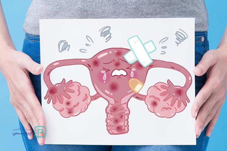 غربالگری سرطان دهانه رحم چیست؟ 0 تا 100 آزمایش غربالگری 9 غربالگری سرطان دهانه رحم