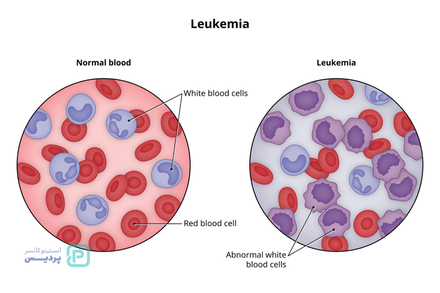 کلینیک کانسر پردیس، همراه شما در مسیر مبارزه با سرطان خون