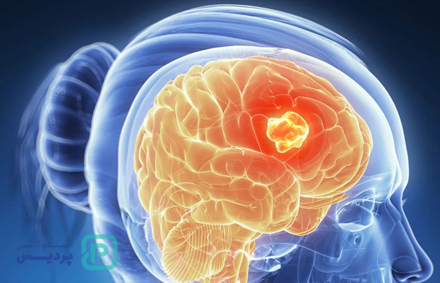 تومور چیست؟ علائم، تشخیص و درمان انواع تومور 4 تومور چیست؟ علائم، تشخیص و درمان انواع تومور - 3