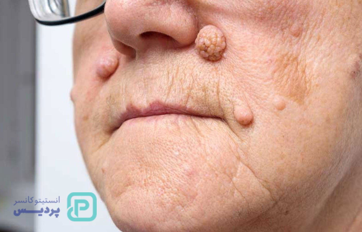 تومور چیست؟ علائم، تشخیص و درمان انواع تومور 3 تومور چیست؟ علائم، تشخیص و درمان انواع تومور - 2