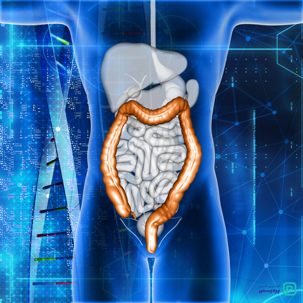 درد سرطان روده بزرگ چگونه احساس میشود؟ - 2