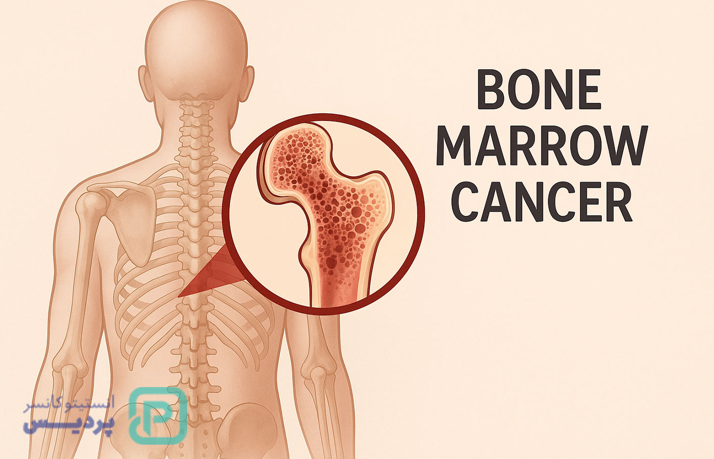 سرطان مغز استخوان چیست؟ علائم، انواع و روش‌های درمان مؤثر - 5