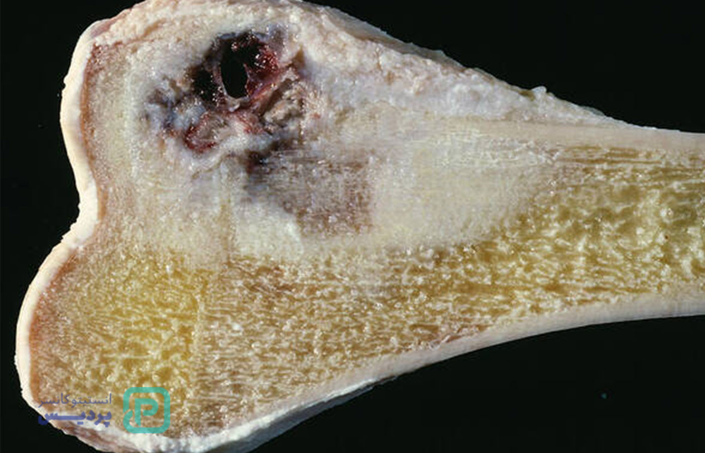 سرطان استخوان چقدر خطرناک است؟ بررسی عوامل کشندگی و درمان 2 سرطان استخوان چقدر خطرناک است؟ بررسی عوامل کشندگی و درمان - 2