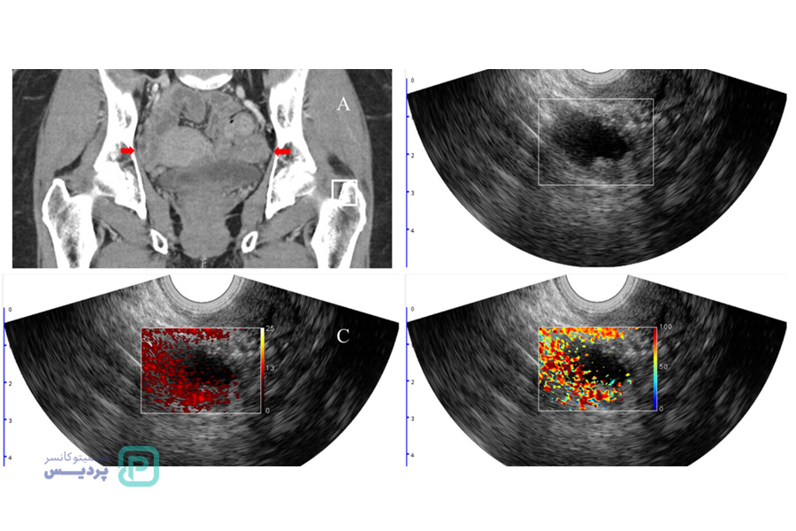 سرطان تخمدان چیست؟ تشخیص و علائم سرطان تخمدان 2 علائم سرطان تخمدان